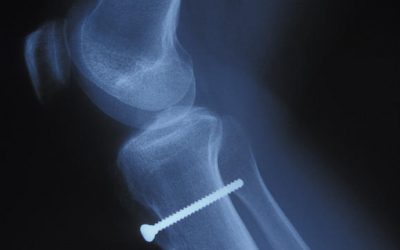 Caso negligencia médica Almería