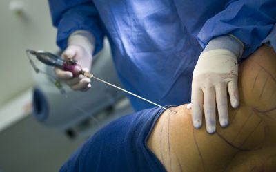 Condenada clínica estética en Almería por liposucción